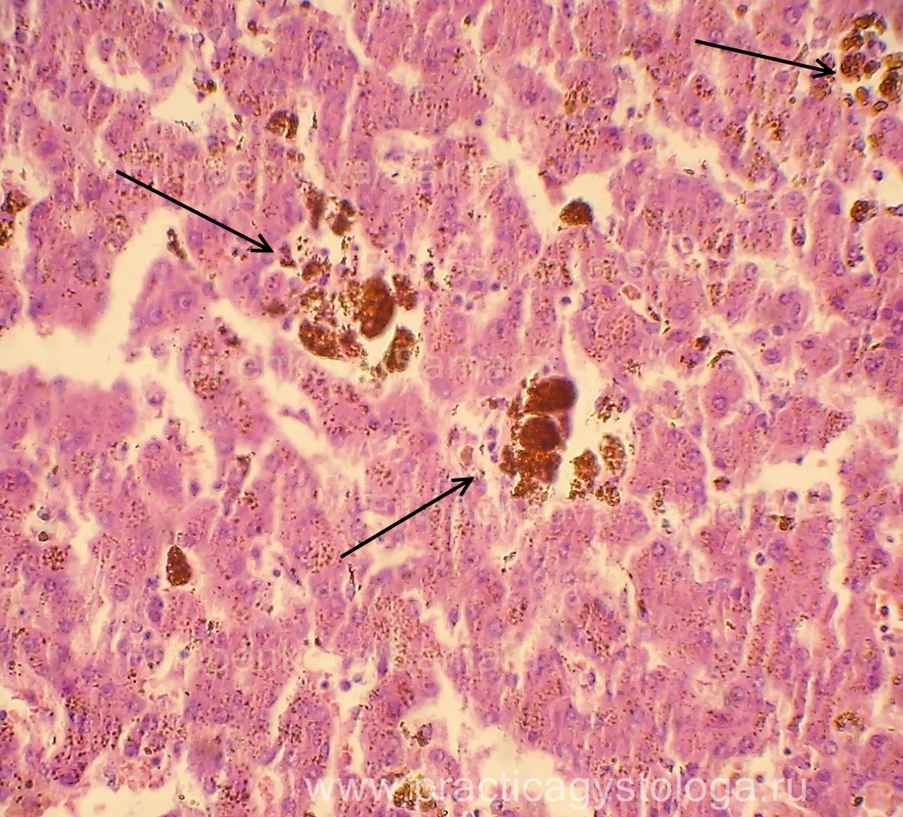 Липофусциноз. Гемосидероз печени гистология. Гемосидероз печени гематоксилин эозин. Гемосидероз селезенки гистология. Липофусцин гистология.